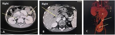 Case Report: Membranoproliferative Glomerulonephritis, a Rare Clinical Manifestation of Abernethy Malformation Type II